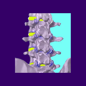 Arthritis in the Spine