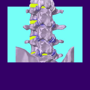 Arthritis Lower Back Pain