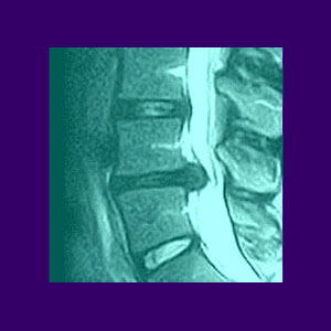Back Pain MRI