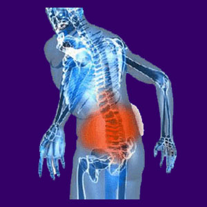 Causes of Herniated Discs