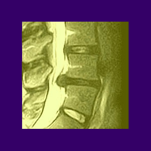 Diagnosis of Spinal Stenosis