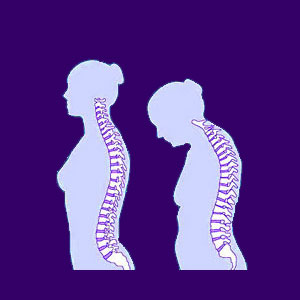 Genetic Back Pain