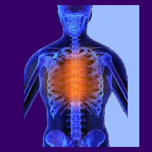 Herniated Discs Do Not Cause Back Pain