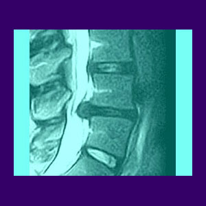 Lumbar Spinal Cord Injury