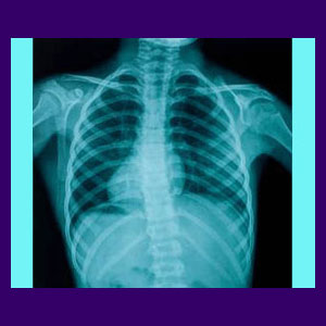 Psychology of Scoliosis