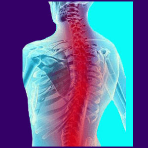 Spinal Stenosis Chiropractor