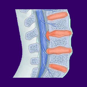 Spinal Stenosis Facts