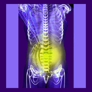 Spondylolisthesis Lower Back Pain