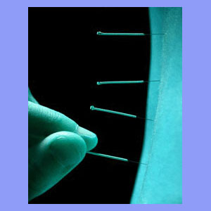 Acupuncture for Sciatica