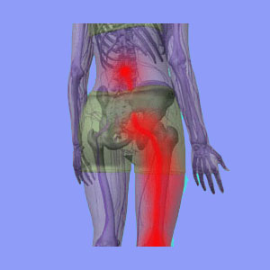Heat or Ice for Sciatica