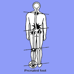 Pronated Foot Sciatica