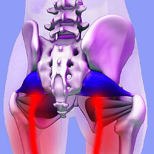Sciatic Nerve Compressed by Piriformis Muscle