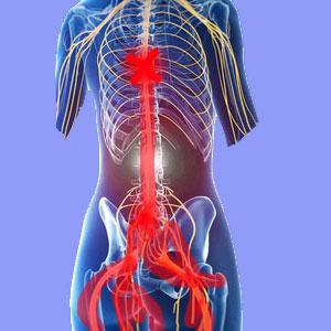 Sciatica and Spinal Cord Injury