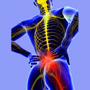 What is it Like to Have Sciatica?
